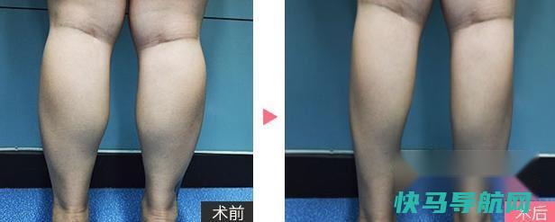 如何瘦小腿肌肉 第2张